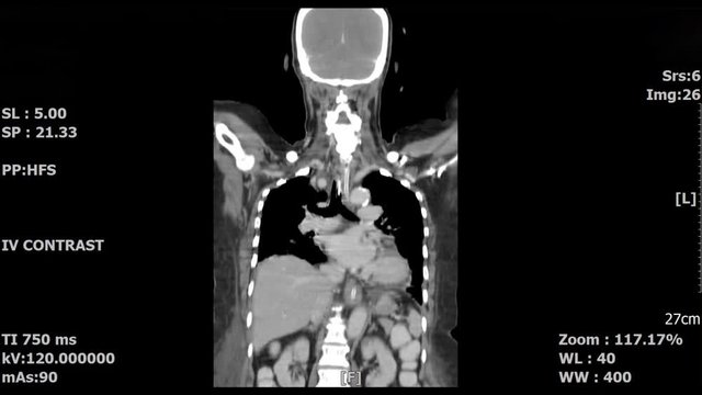 Scanned body scan image by mri scanner on screen computer.