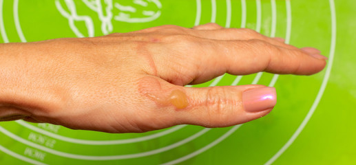 burns blisters from boiling oil on the woman hand closeup