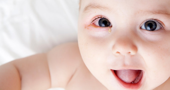 An infant with soured eyes suffers from conjunctivitis