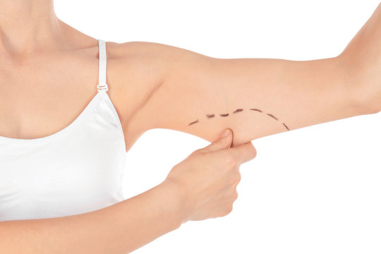 Woman with marks on arm for cosmetic surgery operation against white background, closeup