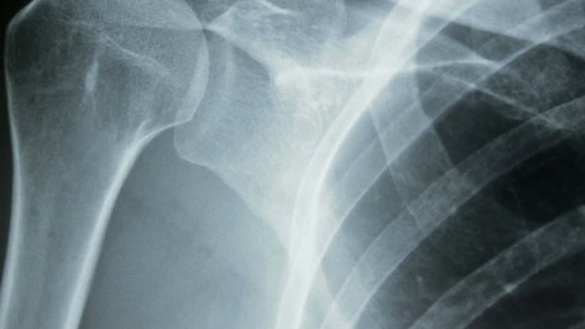 Vertical tracking shot of an x-ray of human shoulder bones, front view.