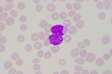 Blast cells on red blood cells background.