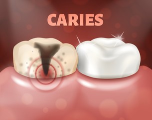 Tooth with caries and healthy tooth. 3d realistic illustration of dental disease. Deep caries on a sick tooth