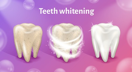 Tooth before, in process and after whitening. Teeth whitening in realistic 3d vector illustration.