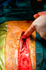 Heart surgery in the surgical operating room