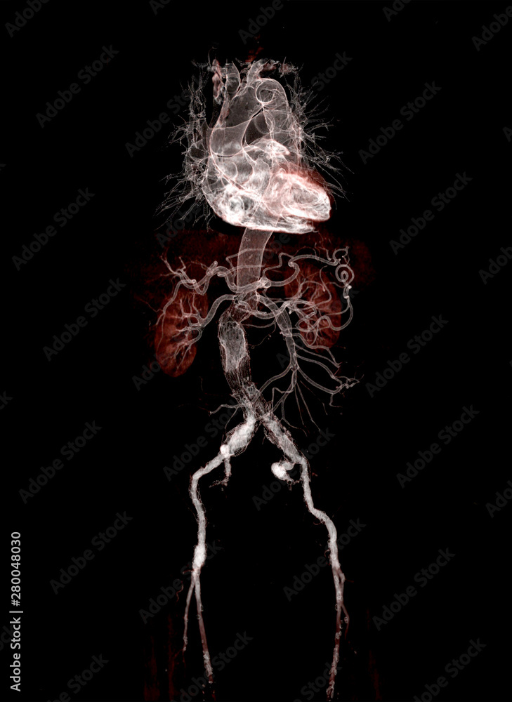 Aufkleber cta abdominal aorta 3d rendering image with stent graft on transparent skeletal .