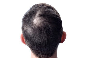 Hair loss.The head of a man with a bald head. White isolate.