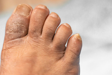 Fungus on the nail. Twisted fingers on the foot with calluses. Bone on the big toe