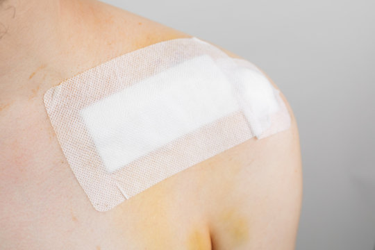 white caucasian male with a broken collarbone / clavicle / clavicula after surgery with a band aid after a bike crash