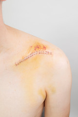 Naklejka premium broken collarbone / clavicle / clavicula post surgery after a bike crash