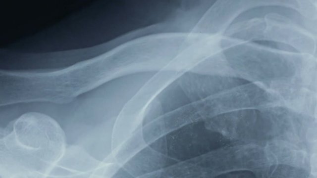 Horizontal tracking shot of an x-ray of human shoulder bones, front view.