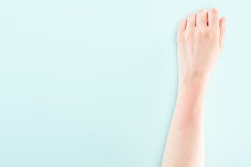 cropped view of hand with allergic reaction isolated on blue