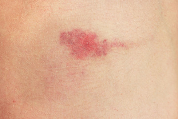 midge mosquito bite. reaction to the bite of midges. allergy. danger of insect bites in the summer. red spot at the bite site after a day