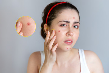 A young pretty brunette looks at her face with pimples. The concept of cosmetology and acne...