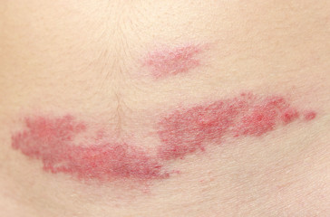 midge mosquito bite. reaction to the bite of midges. allergy. danger of insect bites in the summer. red spot at the bite site after a day
