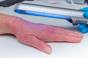 Phototherapy dermatosis. Treatment of skin diseases - psoriasis, ekzemy, dermatitis,...