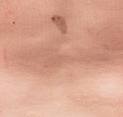 birthmark birthmark on the skin