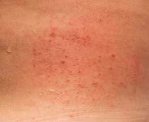 Fototapeta premium allergic rash on the skin of the back