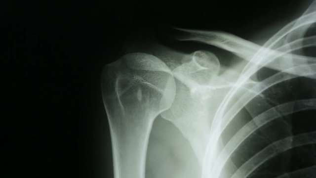 Zoom out, of a radiograph of the bones of the human shoulder, in front view.
