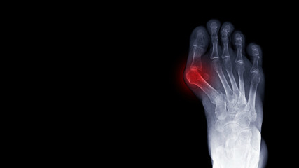 Film x-ray foot radiograph show Hallux valgus deformity or Bunion disease with free copy space and dark background. The patient has toe pain symptom. This cause shoe wearing and cosmetic problem. - obrazy, fototapety, plakaty