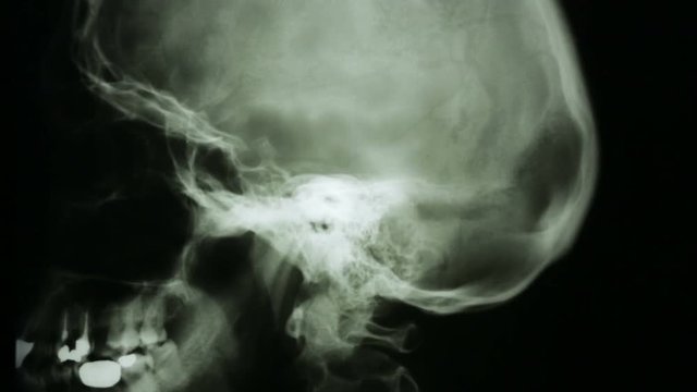 Zoon in, of a radiograph of the bones of the human skull, in lateral view.