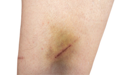 The bruise on a man leg. Injury concept