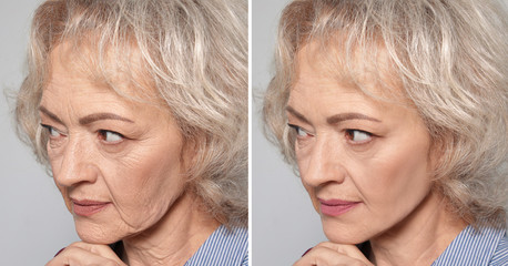 Beautiful mature woman before and after biorevitalization procedure on grey background, closeup