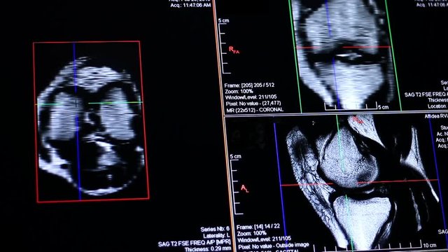Human Knee Magnetic Resonance Imaging MRI.
