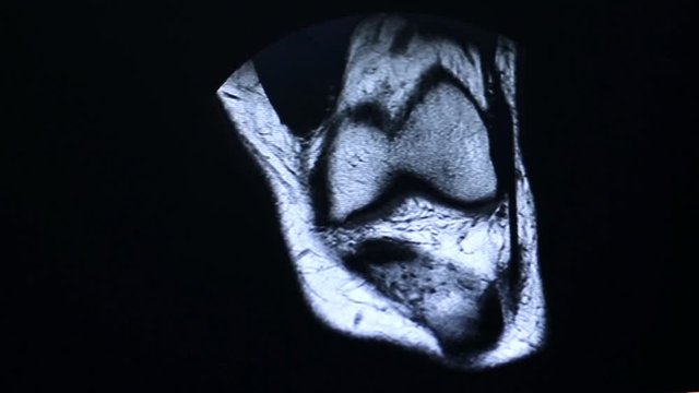 Human Knee Magnetic Resonance Imaging MRI.