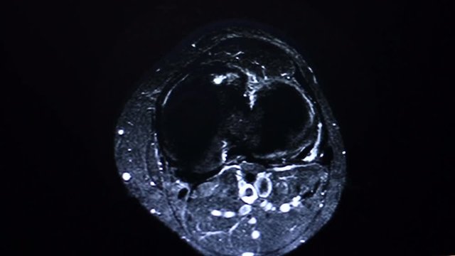 Human Knee Magnetic Resonance Imaging MRI.