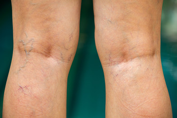 Varicose veins on the back of knees and legs in woman, Blue swimming pool background, Close up and...