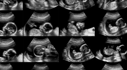 Collection of ultrasonography fetus scans
