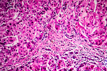 Histopathology of biliary liver cirrhosis, light micrograph, photo under microscope
