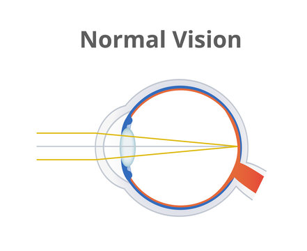 Vector illustration of normal vision – anatomy of healthy eye ball without disorder. The light is focused on the retina. Medical science illustration is isolated on a white background.
