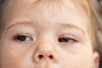 White pimple on the upper eyelid of the eye, milium. Inflammation of the eye of a small baby child, conjunctivitis. Milium is a small, hard, pale keratinous nodule formed on the skin soft focus