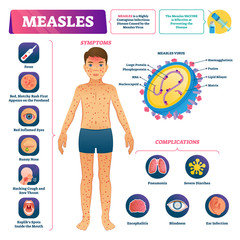 Measles vector illustration. Labeled medical virus disease medical scheme. - obrazy, fototapety, plakaty