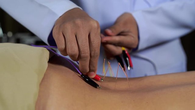 close up woman undergoing acupuncture treatment with electrical stimulator on back