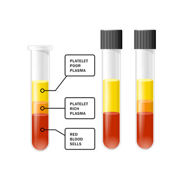 Blood after separation of platelets in the centrifuge in test tube, PRP infographics, platelet-rich plasma