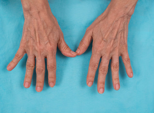 Inicial change in rheumatoid arthritis.  Ulnar deviation