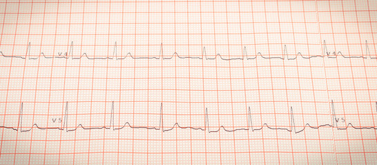 Electrocardiogram graph report, health care and medicine concept