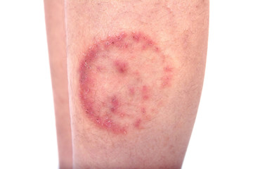 Closeup of ringworm infection or Tinea corporis on skin isolated on white background,  Dermatophytosis on skin isolated