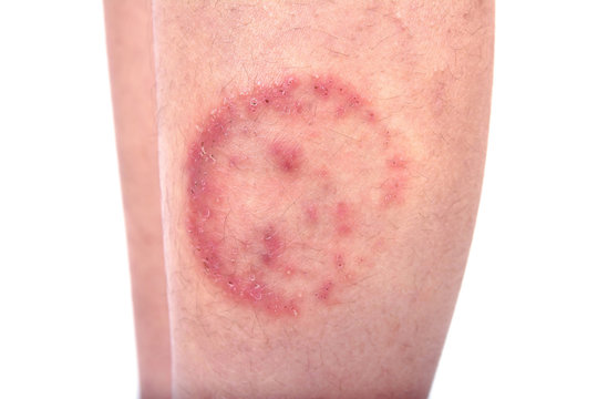 Closeup of ringworm infection or Tinea corporis on skin isolated