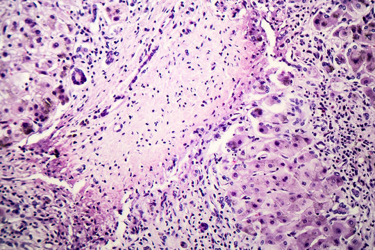 Histopathology of postnecrotic liver cirrhosis, light micrograph, photo under microscope