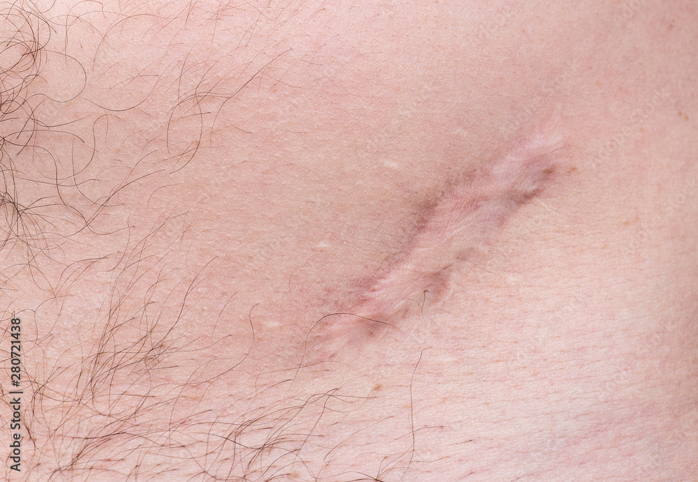 Wall mural scar on human skin scar or cicatrice after operation on stomach