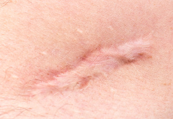 Scar on human skin scar or cicatrice after operation on stomach