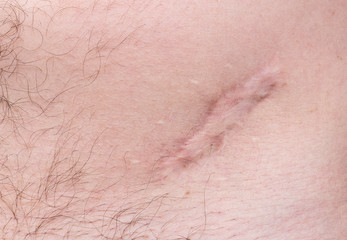 Obraz na płótnie Canvas Scar on human skin scar or cicatrice after operation on stomach