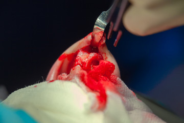 Surgeon and his assistant performing cosmetic surgery on nose in hospital operating room. Nose...