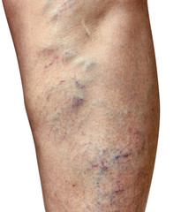 Fototapeta premium Varicose veins on a female legs. Phlebology