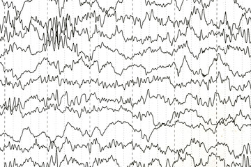 Brain wave patterns on electroencephalogram, EEG of the pediatric patients, problems in the electrical activity of the brain.