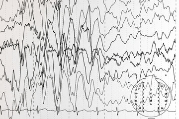 Brain wave patterns on electroencephalogram, EEG of the pediatric patients, problems in the...